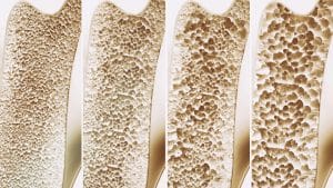 Osteoporosis can cause weak bones