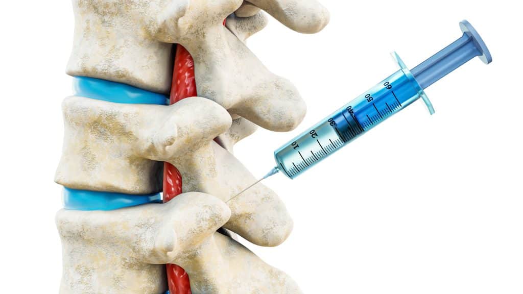 Left Facet Injection Facet Joint Injections in Birmingham, AL | Southside Pain Specialists